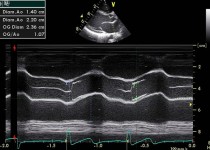 Echodoppler cardiaque pour le dépistage et suivi des maladies cardiaques