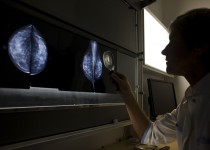 CSMD, mammographie (Fondation Oeuvre de la Croix Saint-Simon)